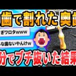 【2ch面白いスレ】虫歯で割れた奥歯をぬこうとしてるだけなのに血だらけ